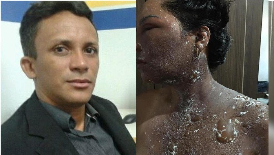 Marido acusado de jogar água quente contra esposa pede para responder em liberdade, no Maranhão